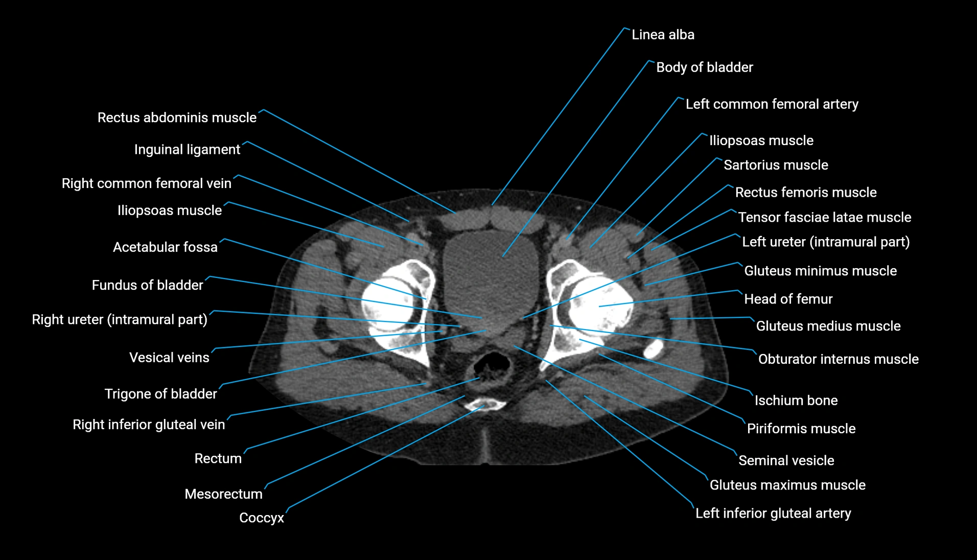 CT urogram axial cross sectional anatomy  labelled radiology image-00230.webp